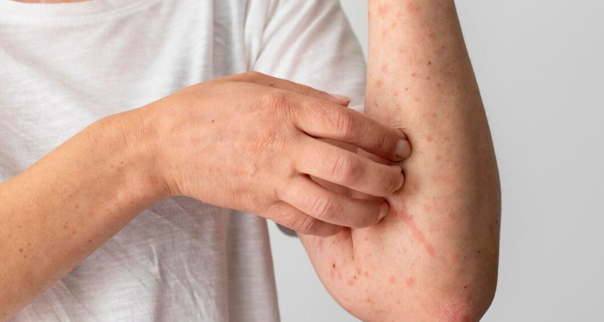 Brasil já registrou 88 casos do vírus Mpox em 2026; saiba como evitar a doença