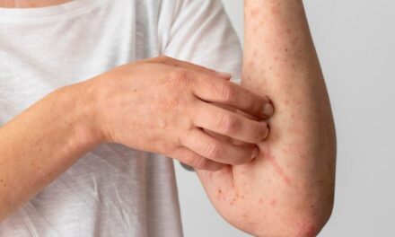 Brasil já registrou 88 casos do vírus Mpox em 2026; saiba como evitar a doença